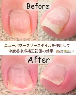ネイル 新宿巻き爪ケア ルポのネイルデザイン