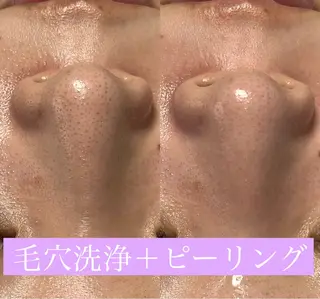 毛穴洗浄🍀脱毛🍀 光フェイシャル🍀のエステ・リラクイメージ
