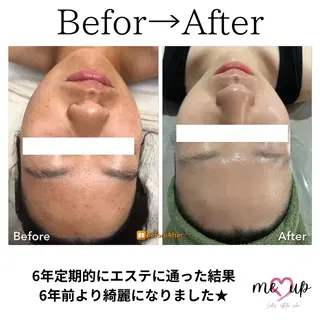 Meupニキビ専門店 背中/ハーブ/肌管理のその他イメージ