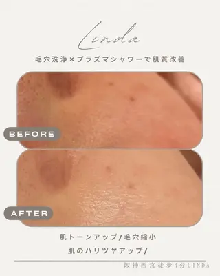 小顔&毛穴・肌質改善 LINDA西宮 AIのエステ・リラクイメージ