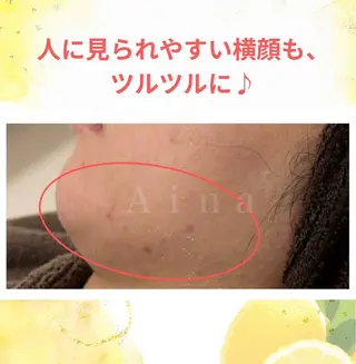 ニキビ跡専門サロン Ainaのエステ・リラクイメージ