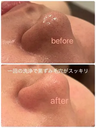 肌質改善Lino 毛穴・ニキビケア専門のエステ・リラクイメージ