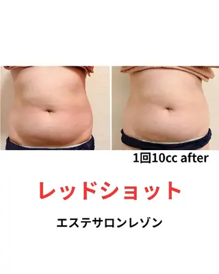 京橋〈ニキビ・ニキビ 跡ケア〉レゾン浅川のエステ・リラクイメージ