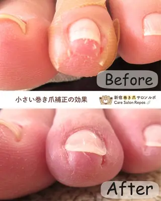 ネイル 新宿巻き爪ケア ルポのネイルデザイン