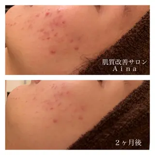 ミディアム カラー パーマ ヘアアレンジ メンズ キッズ ネイル マツエク・マツパ ニキビ跡専門サロン Ａｉｎａのエステ・リラクイメージ