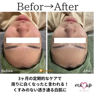 Meupニキビ専門店 背中/ハーブ/肌管理のその他イメージ
