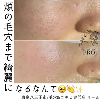 毛穴特化エステ -リールのエステ・リラクイメージ
