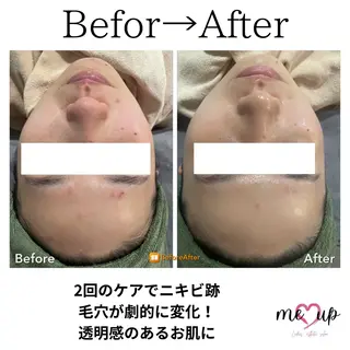 Meupニキビ専門店 背中/ハーブ/肌管理のその他イメージ