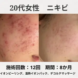 繰り返すニキビ跡専門 根本改善のエステ・リラクイメージ