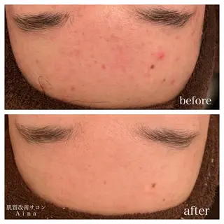 セミロング カラー パーマ ヘアアレンジ メンズ キッズ ネイル マツエク・マツパ ニキビ跡専門サロン Ainaのエステ・リラクイメージ