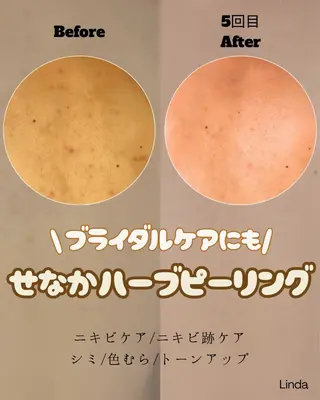 小顔&毛穴・肌質改善 LINDA西宮 AIのエステ・リラクイメージ