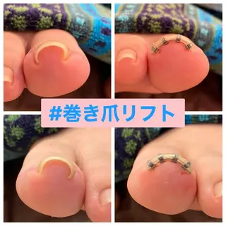 ネイル ♢ME2ROOM♢ #巻き爪#リラクのネイルデザイン