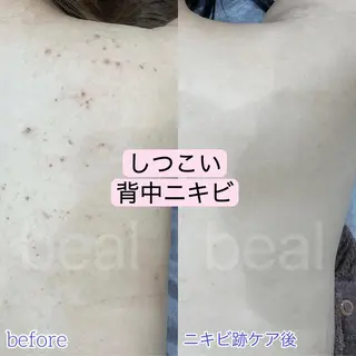 小顔/毛穴/ニキビ salon bealのエステ・リラクイメージ
