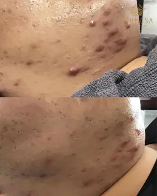 ニキビ•ニキビ跡改善 salon varyのエステ・リラクイメージ