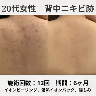 何をしても繰り返す ニキビ・ニキビ跡専門のエステ・リラクイメージ