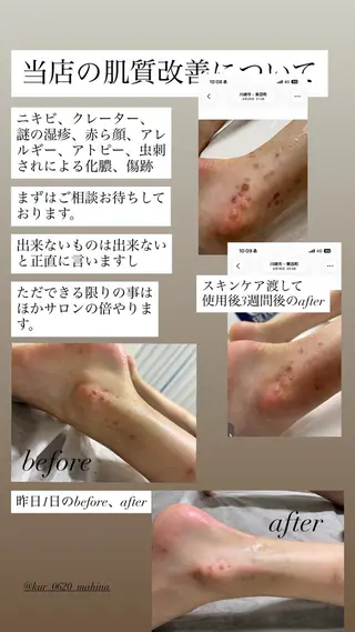 メンズ 肌質改善×都度脱毛 Mahinaのエステ・リラクイメージ