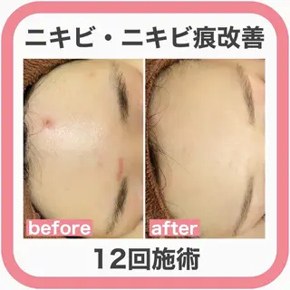 セミロング カラー パーマ ヘアアレンジ メンズ キッズ ネイル マツエク・マツパ アイブロウ 3か月で肌革命👼 ニキビ専門店💫のエステ・リラクイメージ