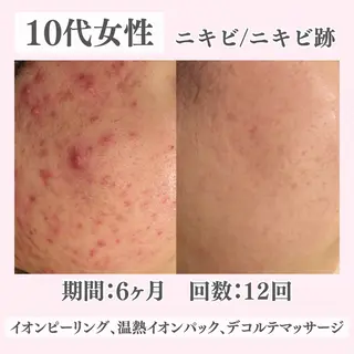 ニキビ・肌質改善専門 ♡人生が変わるサロンのエステ・リラクイメージ