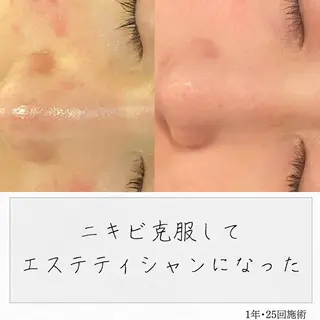 ニキビ経験者が施術 する専門サロン🌻のエステ・リラクイメージ