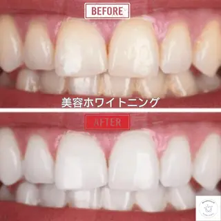 東区香椎歯のセルフホ ワイトニングGLOWのその他イメージ