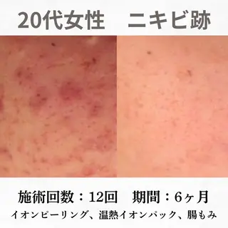 重度ニキビ専門🌼 ダウンタイムなしのエステ・リラクイメージ