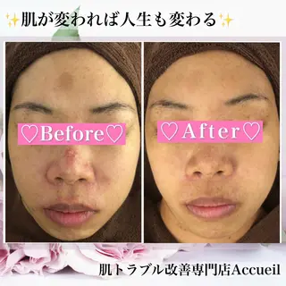 ミディアム カラー パーマ ヘアアレンジ メンズ キッズ ネイル マツエク・マツパ アイブロウ ニキビ・肌質改善専門 ♡人生が変わるサロンのエステ・リラクイメージ