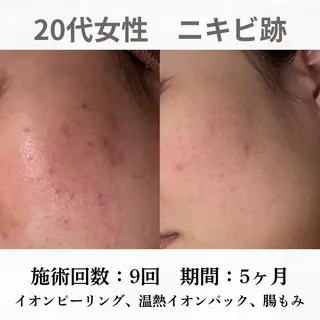 重度ニキビ専門🌼 ダウンタイムなしのエステ・リラクイメージ
