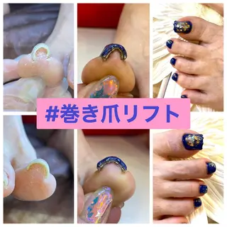 ネイル ♢ME2ROOM♢ #巻き爪#リラクのネイルデザイン