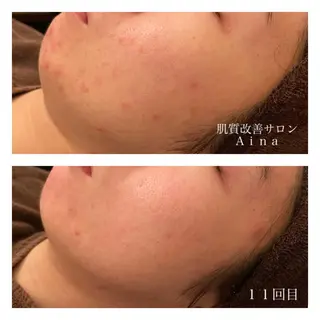 ミディアム カラー パーマ ヘアアレンジ メンズ キッズ ネイル マツエク・マツパ ニキビ跡専門サロン Ainaのエステ・リラクイメージ