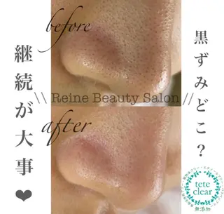 毛穴/シミ肝斑/脱毛 横山梨里のエステ・リラクイメージ