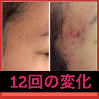 ミディアム パーマ ヘアアレンジ メンズ キッズ ネイル マツエク・マツパ ニキビ・肌質改善専門 ♡人生が変わるサロンのエステ・リラクイメージ