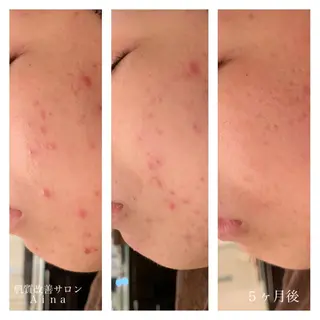セミロング カラー パーマ ヘアアレンジ メンズ ネイル マツエク・マツパ ニキビ跡専門サロン Ainaのエステ・リラクイメージ
