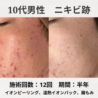 繰り返すニキビ跡専門 根本改善のエステ・リラクイメージ