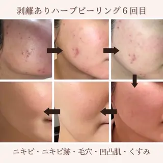 ENoa ハーブピーリング専門のエステ・リラクイメージ