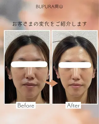 小顔矯正＆肌質改善 BUPURA岡山のエステ・リラクイメージ