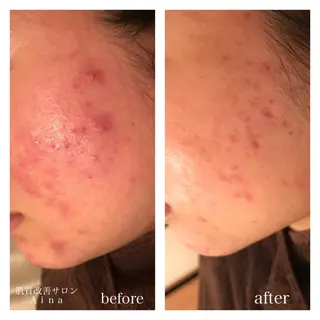 セミロング カラー パーマ ヘアアレンジ メンズ キッズ ネイル マツエク・マツパ ニキビ跡専門サロン Ainaのエステ・リラクイメージ