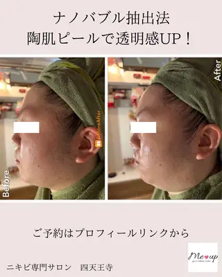 Meupニキビ専門店 背中/ハーブ/肌管理のその他イメージ