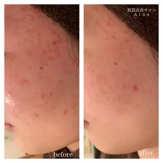 ミディアム カラー パーマ ヘアアレンジ メンズ キッズ ネイル マツエク・マツパ ニキビ跡専門サロン Ainaのエステ・リラクイメージ