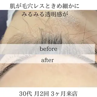 シミニキビ改善 小顔サロンのエステ・リラクイメージ
