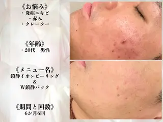 何をしても繰り返す ニキビ・ニキビ跡専門のエステ・リラクイメージ