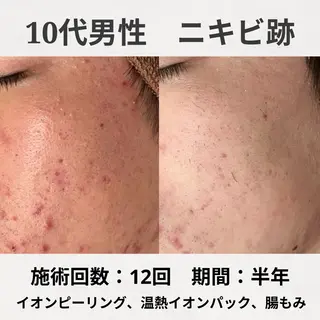 ニキビ跡改善専門🔥 医療にはできない改善のエステ・リラクイメージ