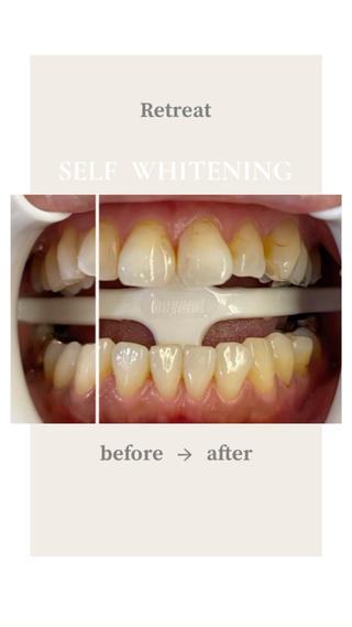 ※ノーマルカメラ加工無し


2回ご来店頂きました！

1回目より2回目、2回目より3回目と
トーンアップと共に定着率も上がるため
後戻りしにくい歯になります 