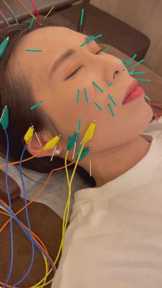 美容鍼に電気を流しています。
筋肉をほぐして、よりエイジングに特化しています。
痛みはなく、電気が心地よく感じます！
ぜひご体感下さい☆ 