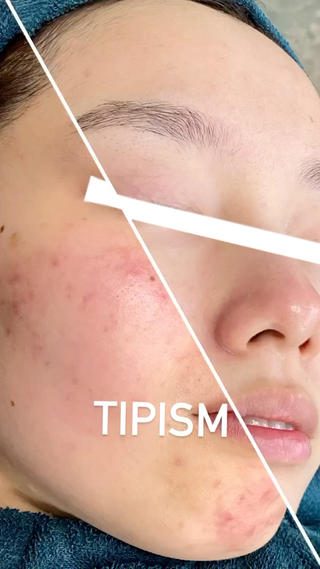 TIPハーブピーリングのbefore afterです
この肌質改善はハーブとプラセンタの力で
肌を根本的に甦らせます
約5〜7日間で新しい細胞を育てます
〜TIPハーブピーリングの特徴〜
肌をこすって摩擦をかけません。
よくあるハーブピーリングは肌をこするなど
ハーブを肌に入れる際に摩擦が起こります。
その時に強い痛みも感じられる方が多いですが
摩擦レス。手の圧でハーブを毛穴入れ込みます。
痛みも抑えられハーブ経験者のお客様からは
痛みが違うと驚かれる方も多いです
皮向け.剥離もなくここまで肌が変わるTIPハーブ
凄いです
(株)三・一・五 症例より引用