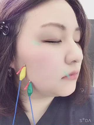 リフトアップ、ほうれい線に対してのアプローチ例。
目元のくすみ、シミにもアプローチしております