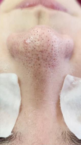 上本町/谷町九丁目/美肌脱毛/全身脱毛/顔脱毛/毛穴洗浄 