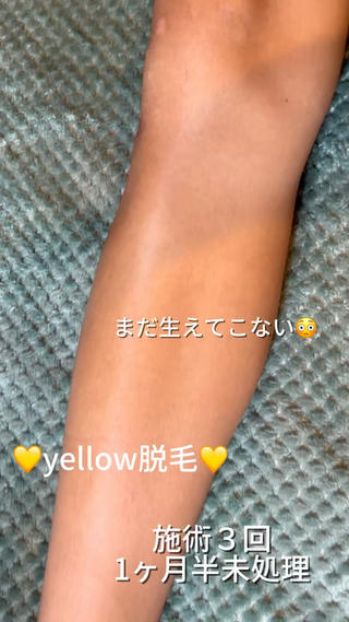 yellow💛【 脱毛&フェイシャル】のエステ・リラクイメージ