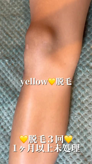 yellow💛【 脱毛&フェイシャル】のエステ・リラクイメージ