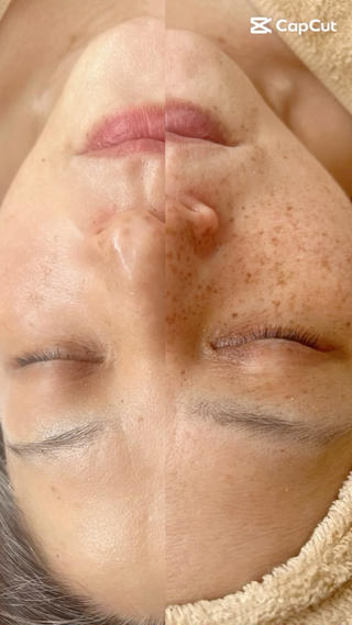 陶肌トリートメント（剥けないハーブピーリング）×幹細胞ミスト

継続12回

40代美肌革命⟡.· 