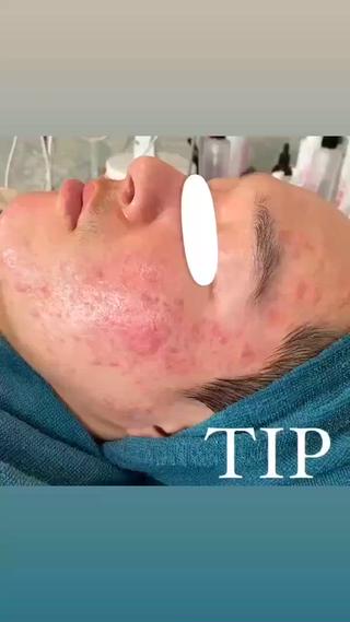 ニキビ、ニキビ跡へアプローチ！
炎症後色素沈着により赤みが消えないニキビ跡にもハーブピーリングがおすすめです。
内側から元気な細胞を育てていきます。 